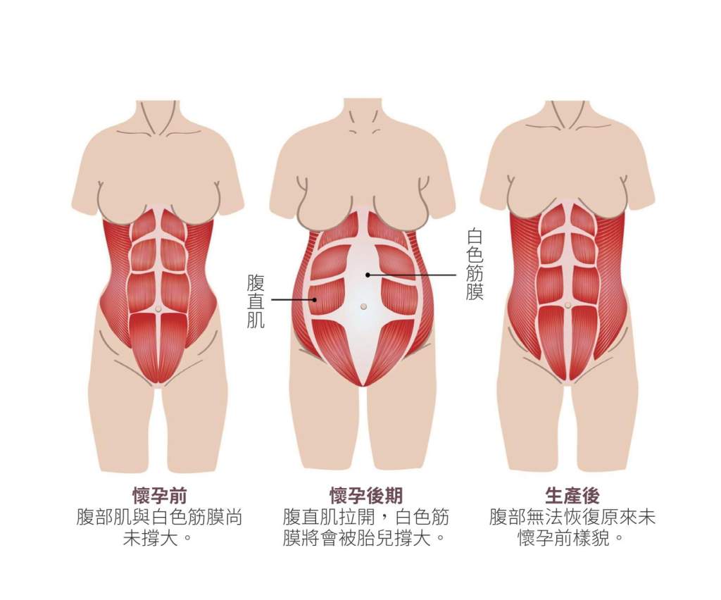 生產後腹部贅肉成因